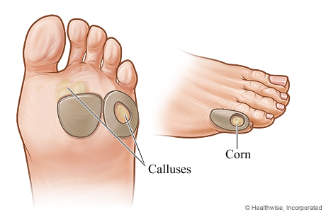 Pads on corn on little toe and on calluses on bottom of foot