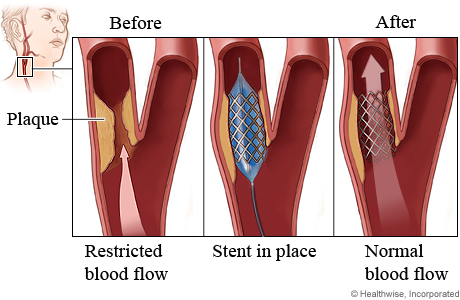 Carotid angioplasty procedure