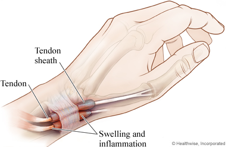 Tendon affected by de Quervain's tenosynovitis