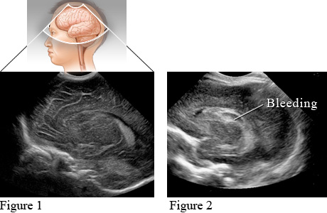 Cranial ultrasound