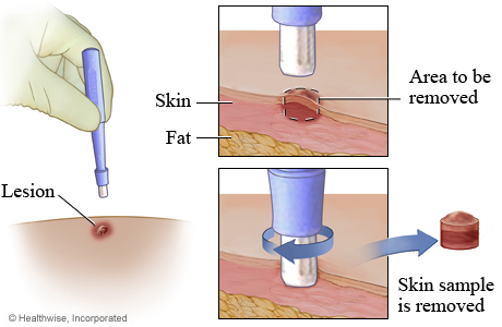 Punch biopsy