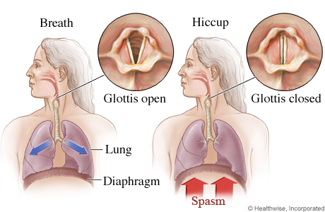 How hiccups occur